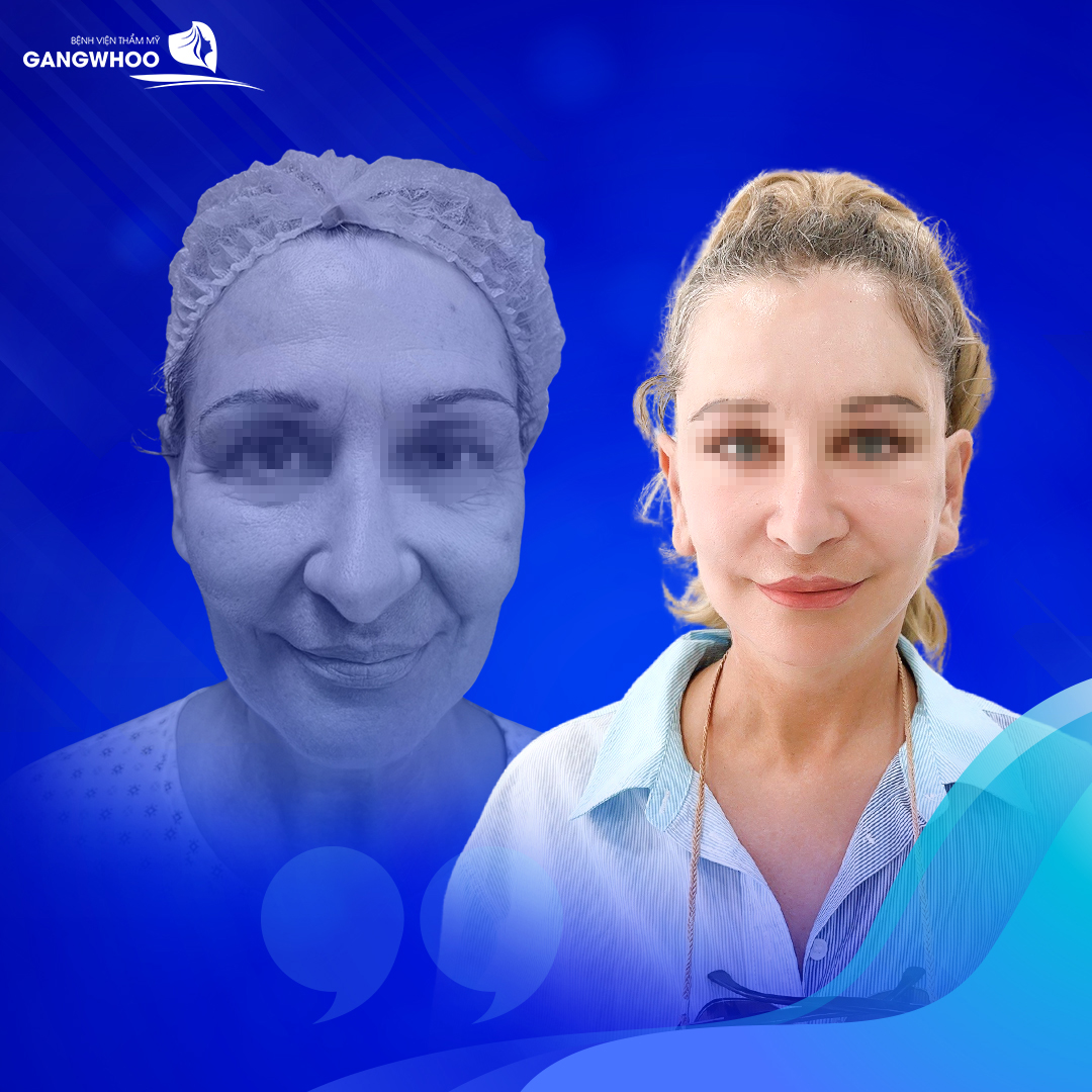 Khách Việt kiều chọn BVTM Gangwhoo căng da mặt dịp Tết 2023 - 1