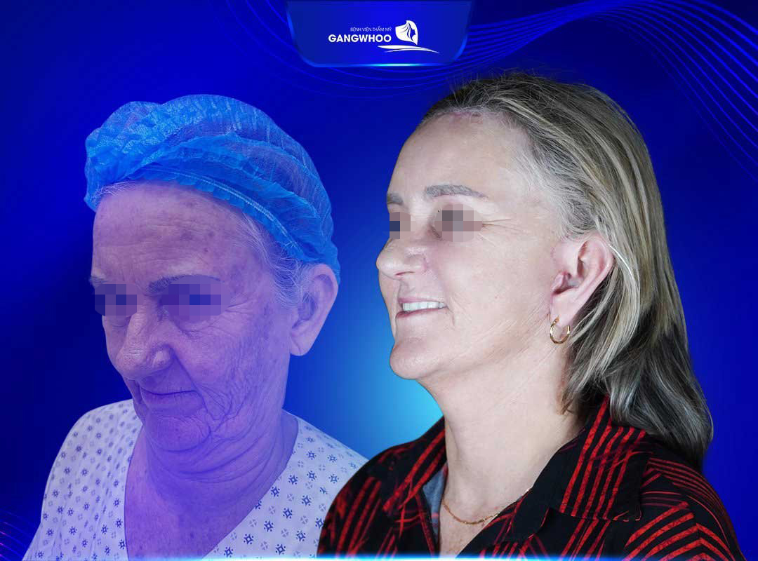 Khách Việt kiều chọn BVTM Gangwhoo căng da mặt dịp Tết 2023 - 3