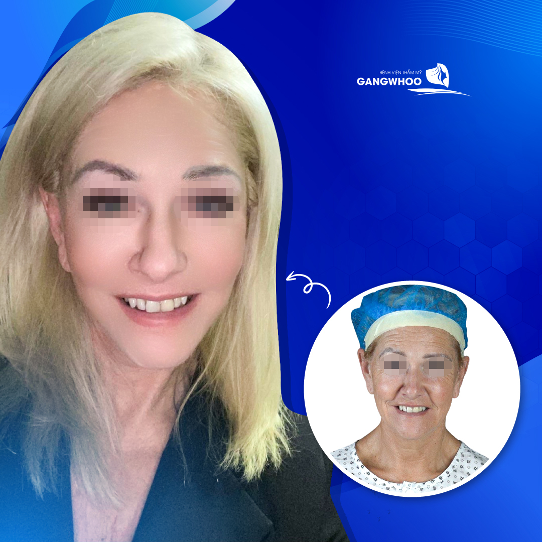 Khách Việt kiều chọn BVTM Gangwhoo căng da mặt dịp Tết 2023 - 4