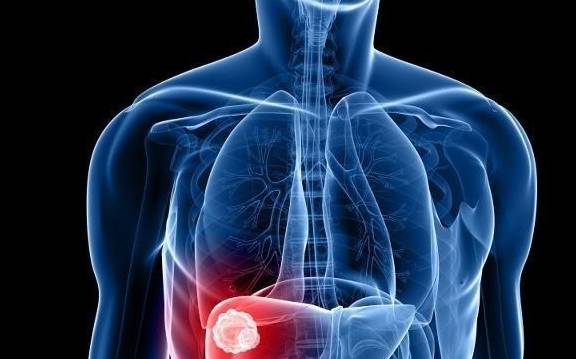 Đừng bỏ qua những cơn đau vai gáy thường xuyên, đó có thể là dấu hiệu sớm của ung thư gan - 1