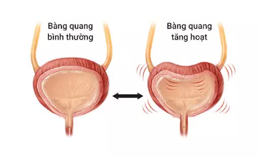 Bí mật khiến người phụ nữ mất ngủ triền miên, không dám đi xa, ra vào nhà vệ sinh liên tục - 3