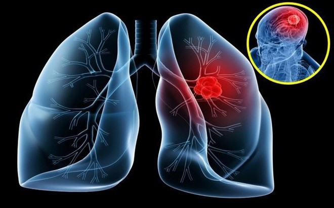Bác sĩ viện K tư vấn cách phòng tránh ung thư phổi - 1
