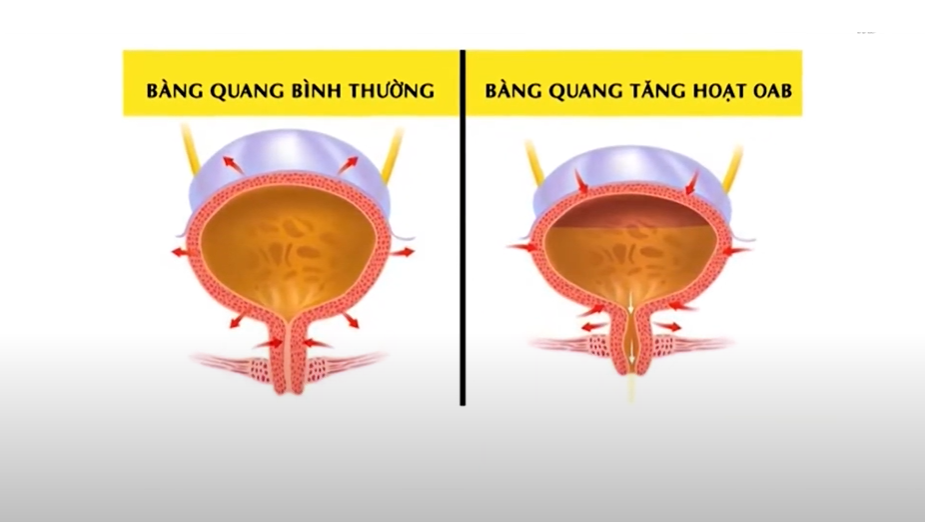 Phụ nữ dễ mắc tiểu đêm, tiểu không tự chủ vì lý do không ai ngờ tới! - 2