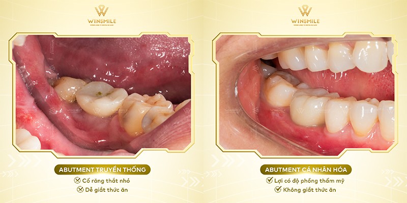 Trồng răng cá nhân hóa - Xu hướng nha khoa hiện đại - 3