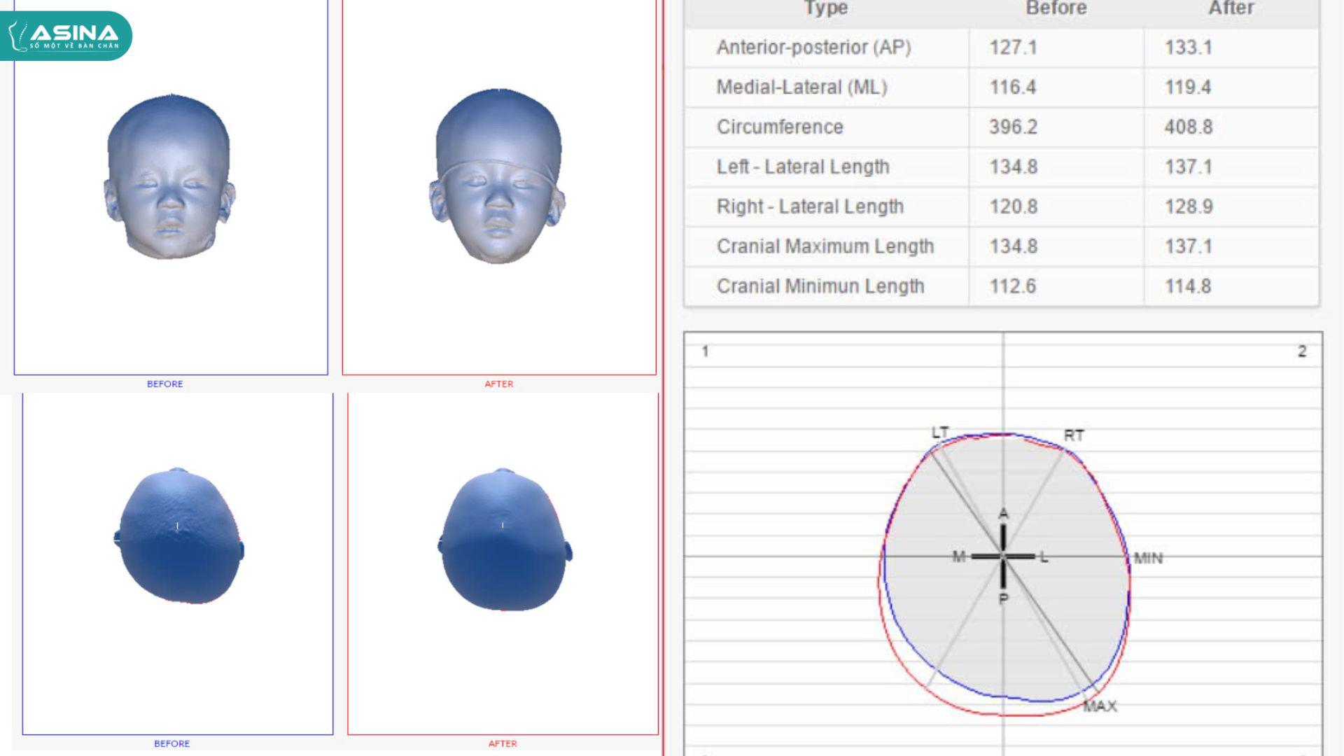ASINA – Đơn vị tiên phong ứng dụng công nghệ 3D trong điều trị hội chứng đầu méo, đầu bẹt cho trẻ em Việt Nam - 2