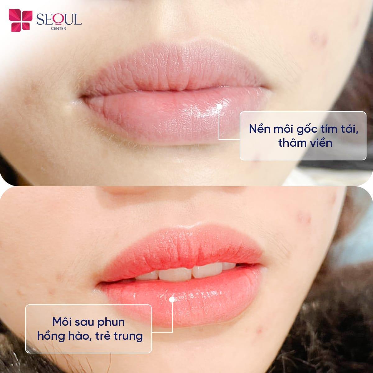 Thẩm mỹ viện Seoul Center - Điểm đến phun môi đẹp, an toàn, bền màu - 2