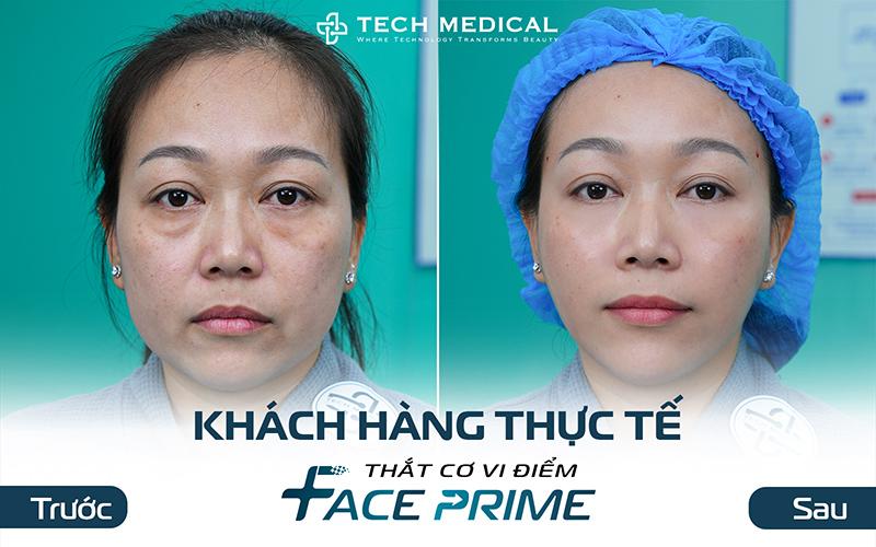 Thắt cơ vi điểm - xu hướng trẻ hóa ít xâm lấn trong năm 2026 - 3