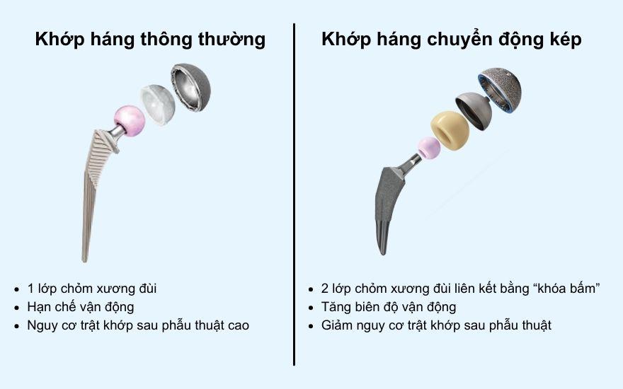Khớp háng nhân tạo chuyển động kép thế hệ mới - giảm 93% nguy cơ trật khớp - 1