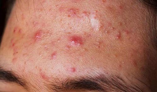 Đàn ông con trai bị mụn: Chấm dung dịch này mỗi tối là sạch sẽ, không cần đi Spa với bôi kem như con gái - 1