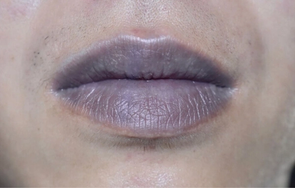 3 dấu hiệu trên mặt cảnh báo phổi “gặp hạn”, đừng chậm trễ kẻo “tử thần gõ cửa”! - 2