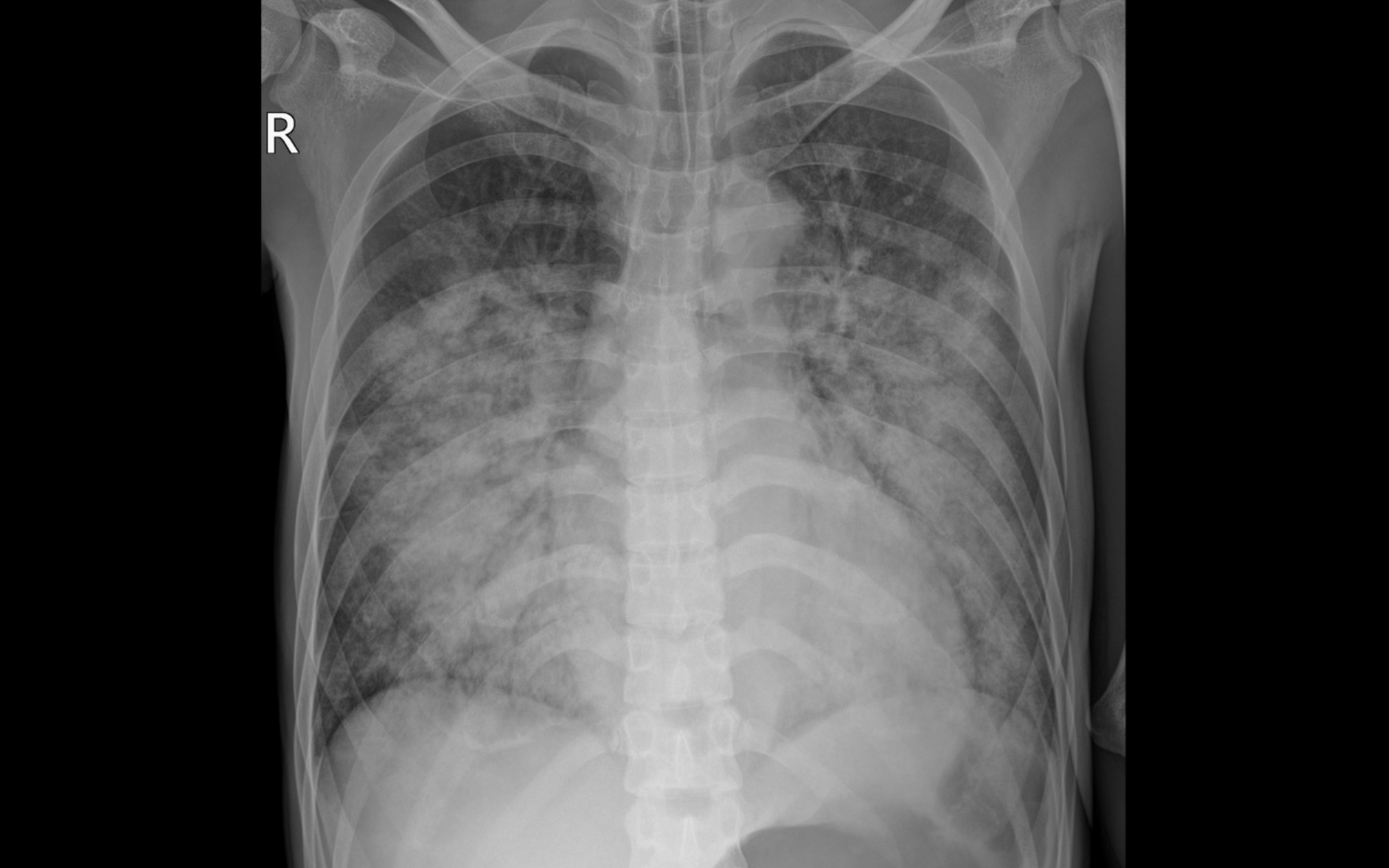 Tưởng ho thông thường, nam thanh niên rơi vào nguy kịch vì suy tim cấp - 1