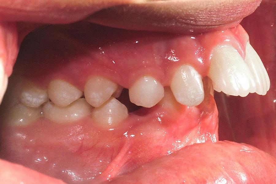 Niềng răng hô có cần nhổ răng không? Chuyên gia giải đáp - 1