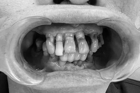 Bị mất răng phải làm sao và những giải pháp phục hình tối ưu - 1