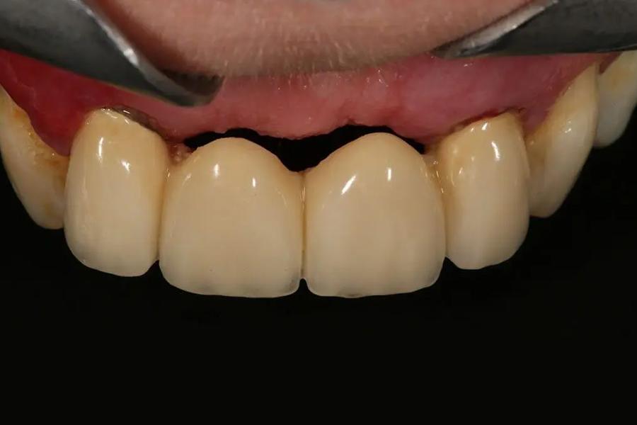 Bị mất răng phải làm sao và những giải pháp phục hình tối ưu - 3