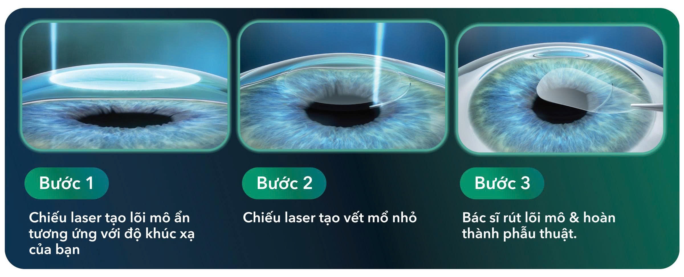 Xóa cận vết mổ nhỏ và sự phát triển hướng đến bảo tồn mô giác mạc - 1