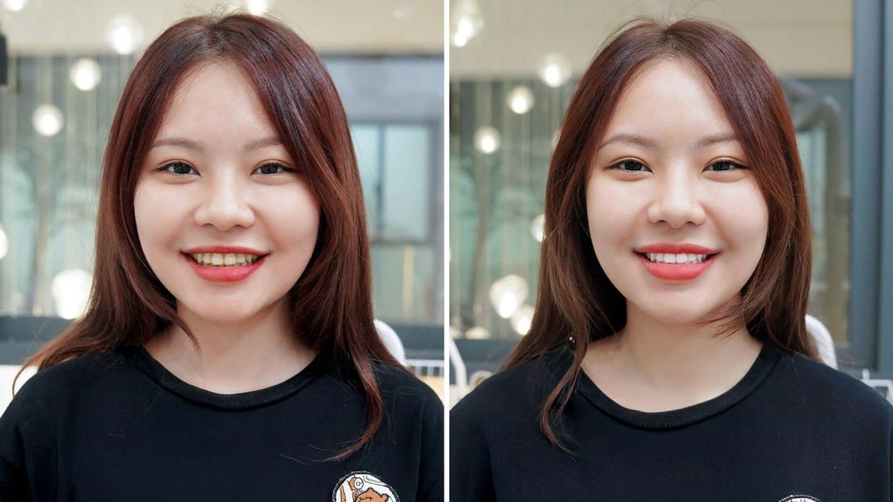 Nên tẩy trắng răng tại nhà hay đến nha khoa? - 3