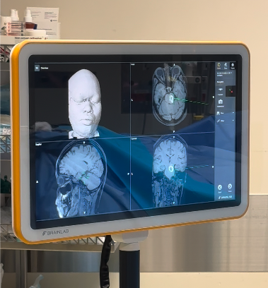 Bác sĩ FV bóc trọn khối u 2cm trong não bệnh nhân nhờ công nghệ định vị Navigation thế hệ mới - 2