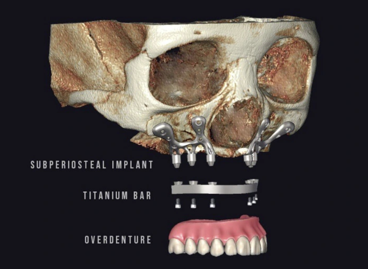 Ứng dụng thành công kỹ thuật Implant cá nhân hoá cho bệnh nhân không răng bẩm sinh tại Việt Nam  - 2