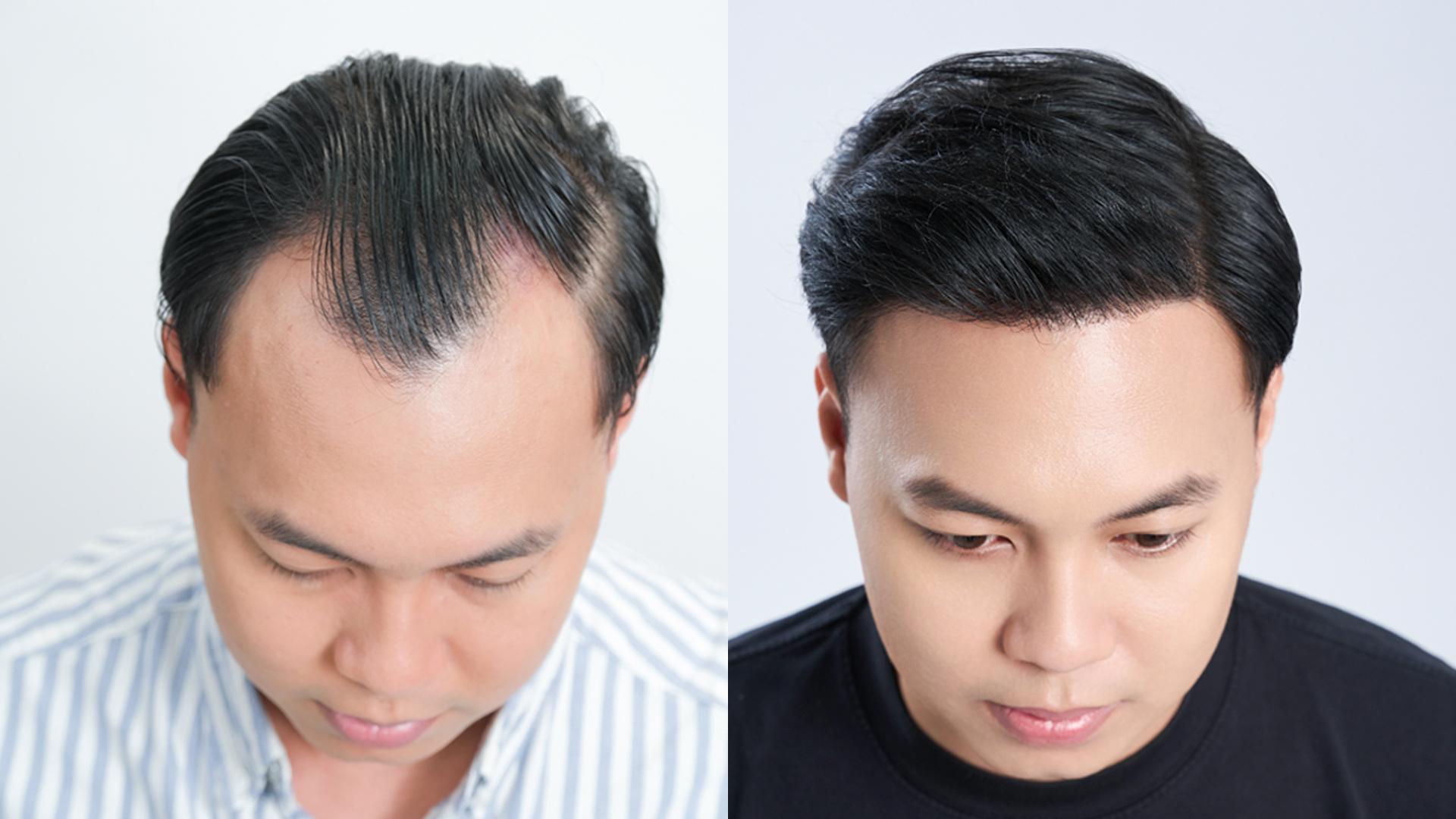 Cấy tóc tự thân qua lời chia sẻ của chuyên gia nước ngoài tại VTV9 - 2