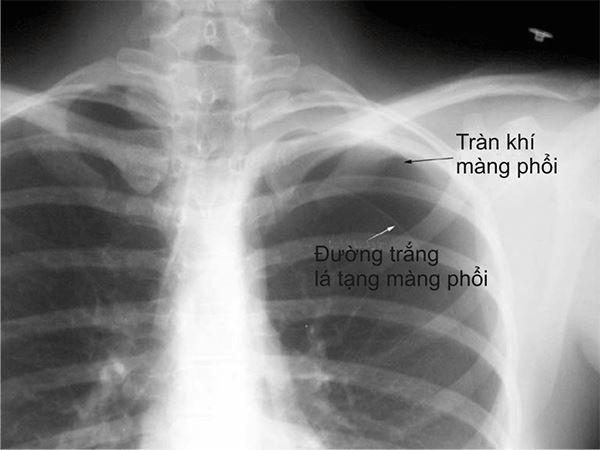 Cẩn trọng với 3 biến chứng "tai hại" khi bị đàm, ho, khó thở lâu năm! - 2