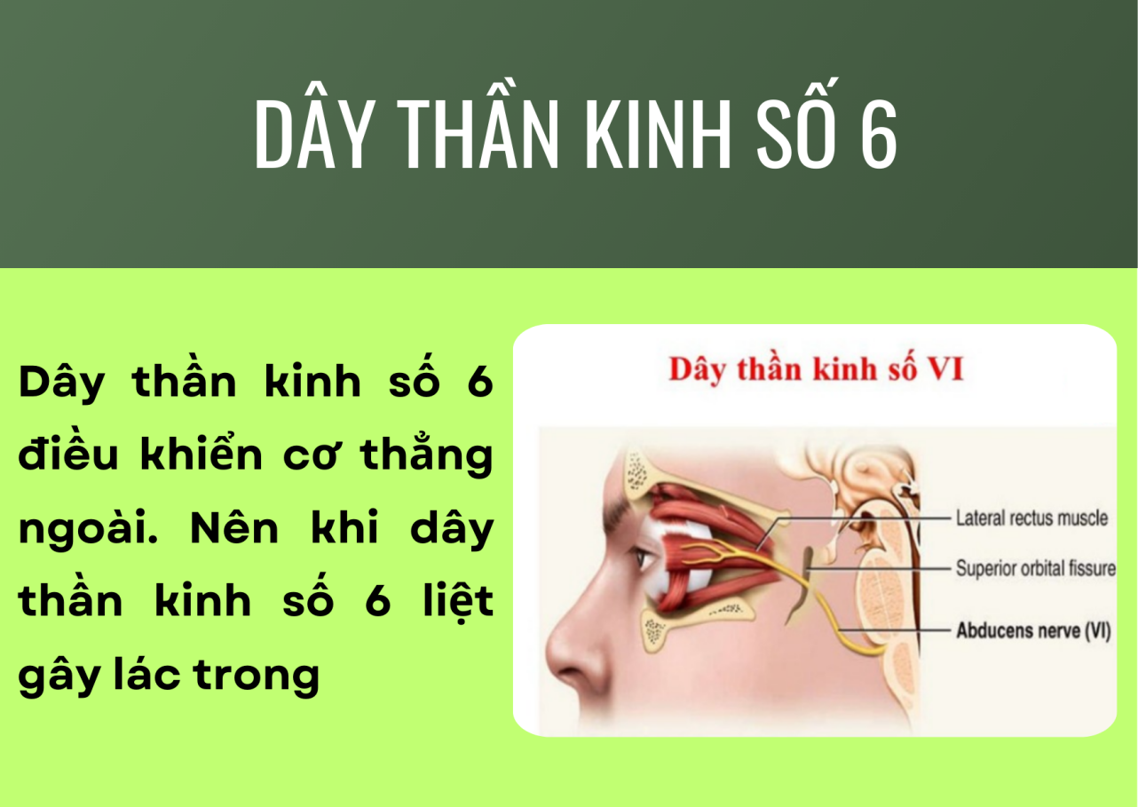 Tại sao liệt dây thần kinh số 6 gây lác trong - 1