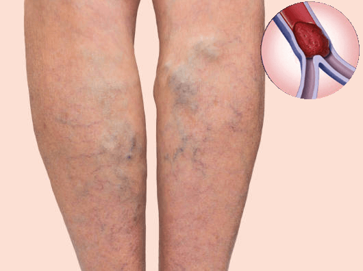 TPBVSK và Kem bôi Vein Thái Minh - Giải pháp mới hỗ trợ suy giãn tĩnh mạch - 2