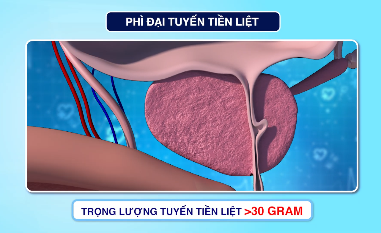 Uống loại nước quen thuộc giúp “lợi tiểu”, nhiều người lại phải thức dậy 3–4 lần mỗi đêm vì sai lầm này - 2