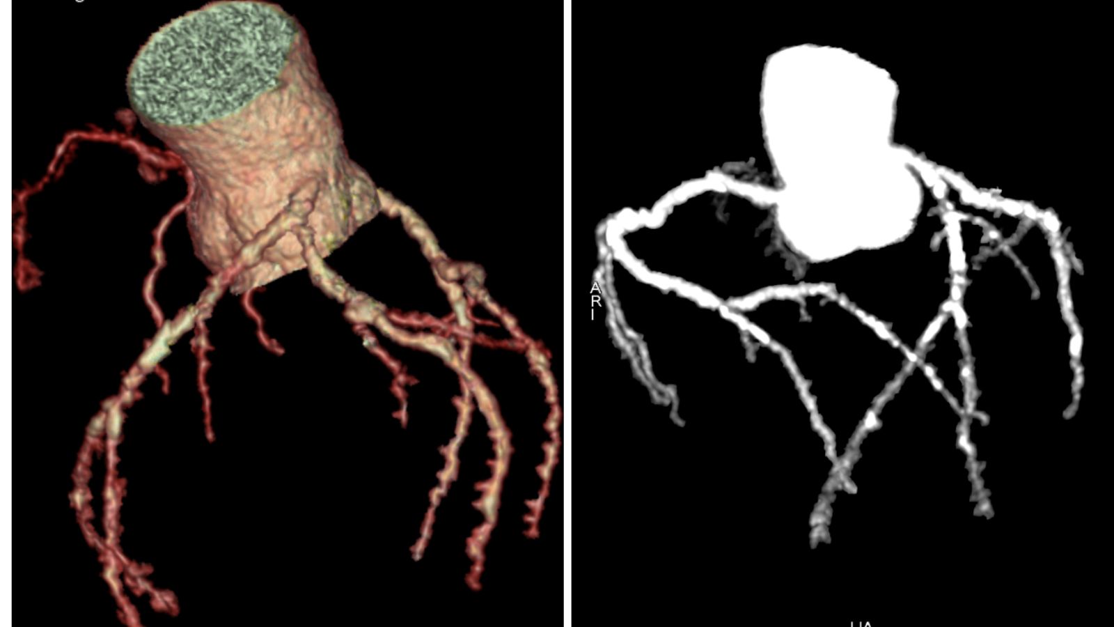 Ho 2 tuần không khỏi, bàng hoàng phát hiện hẹp nặng 3 mạch máu nuôi tim - 1