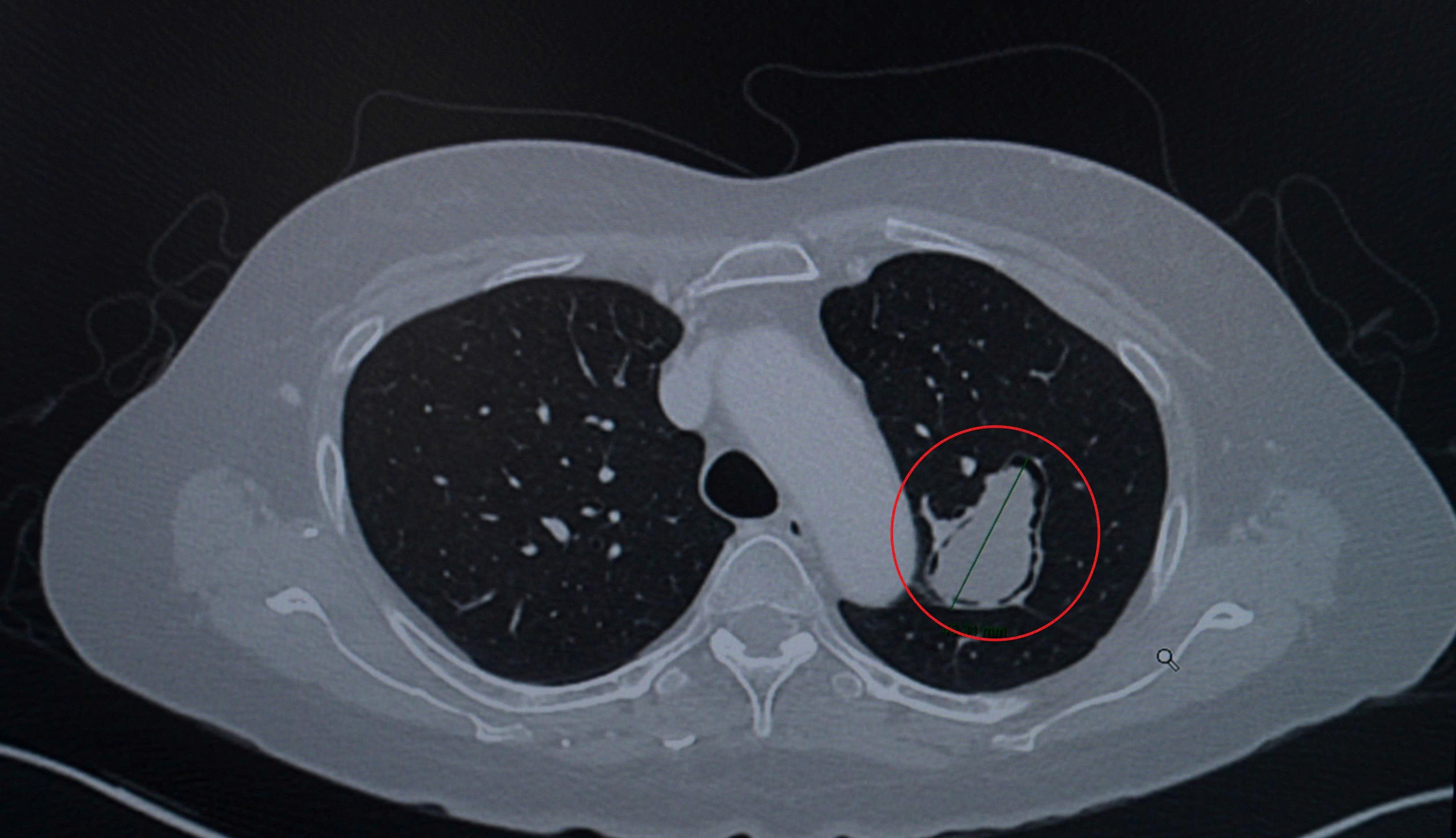 Dùng Robot phẫu thuật thành công cho bệnh nhân mắc u nấm phổi kèm nguy cơ “ho ra máu sét đánh” - 1
