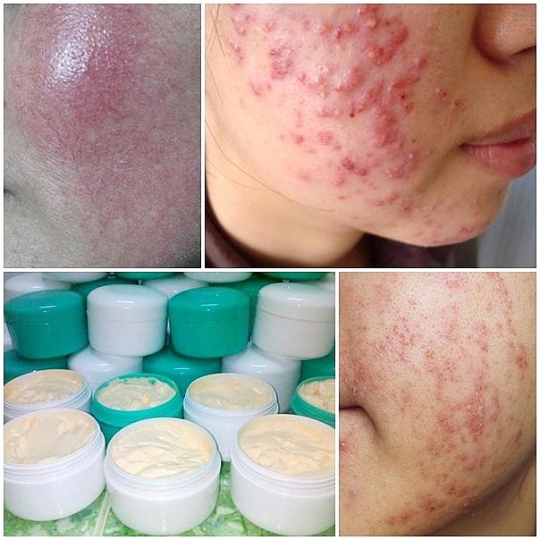 Sau Hydroquinone, người dùng nên kỳ vọng gì ở một sản phẩm làm sáng da lành tính? - 1