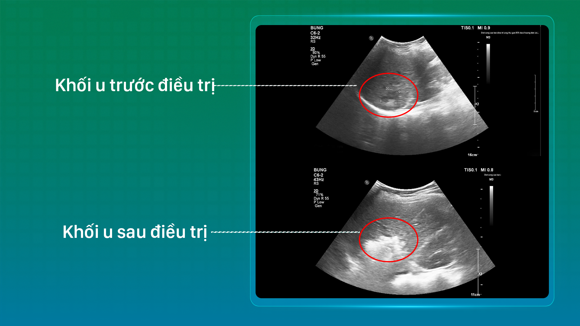 “Sạch” u gan sau 30 phút: Bước tiến từ CT Photon và RFA tại Bệnh viện Đa khoa Phương Đông - 2