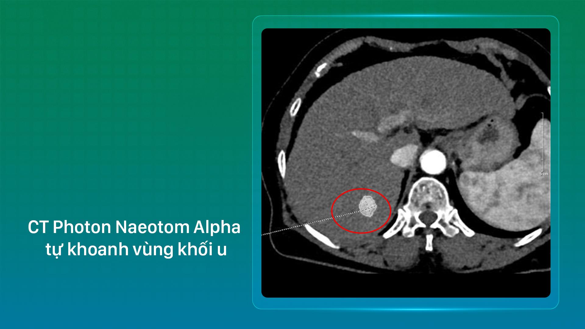 “Sạch” u gan sau 30 phút: Bước tiến từ CT Photon và RFA tại Bệnh viện Đa khoa Phương Đông - 1