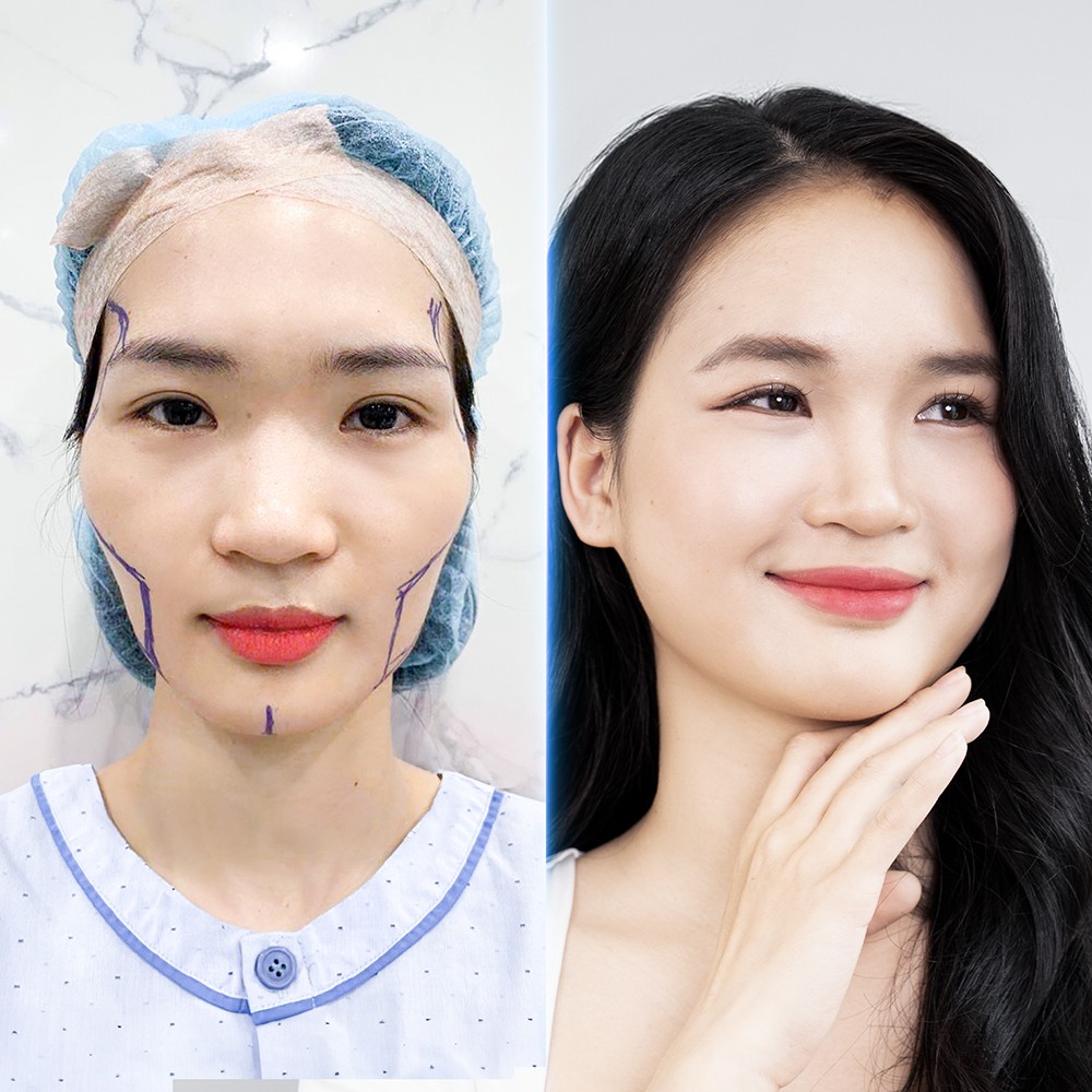 Cấy mỡ tự thân thế hệ mới: Hướng đi hiện đại cho vẻ đẹp an toàn và bền vững - 3