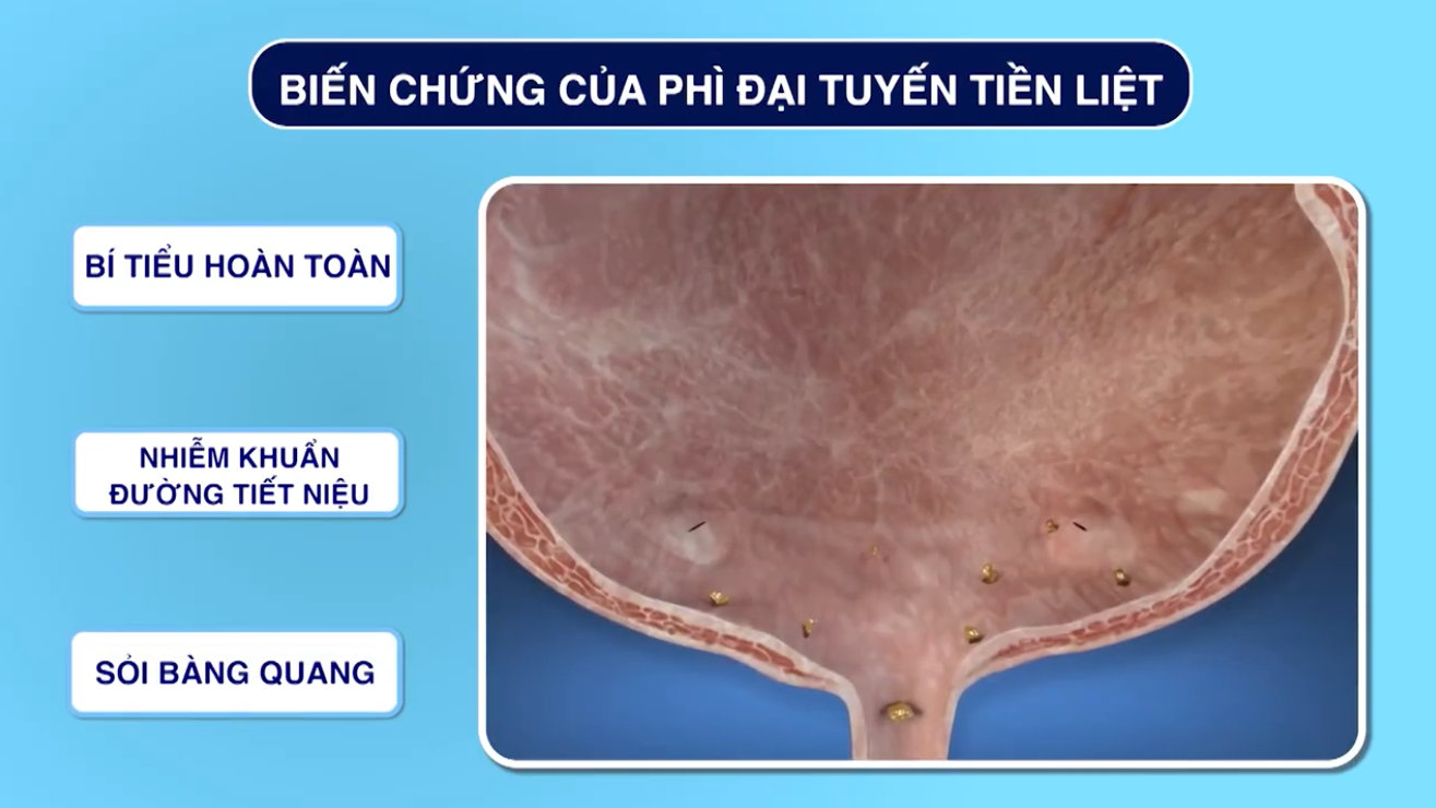Mùa hè càng nóng càng tiểu nhiều? Bác sĩ cảnh báo 4 thói quen nhiều người đang làm sai - 2