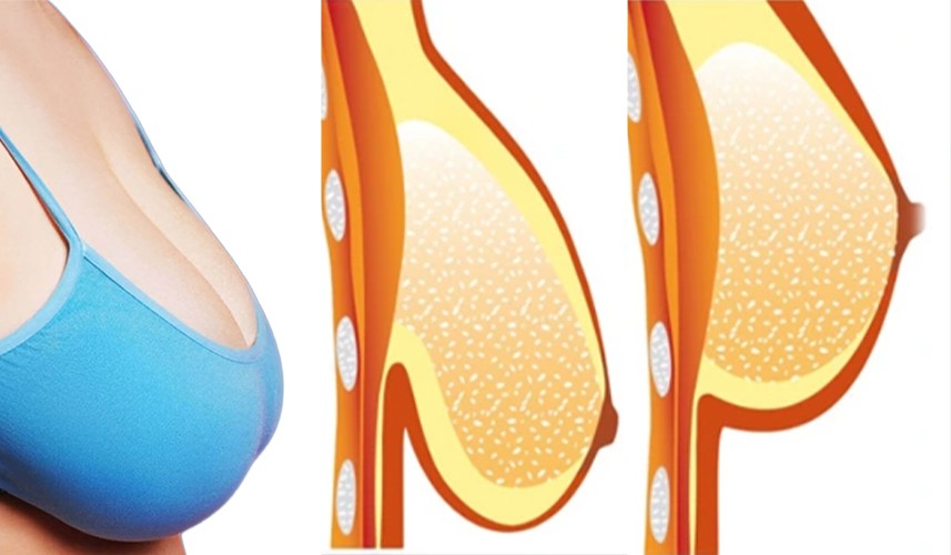Ngực sa trễ sau sinh: Điều nhiều phụ nữ ngại nói - 2