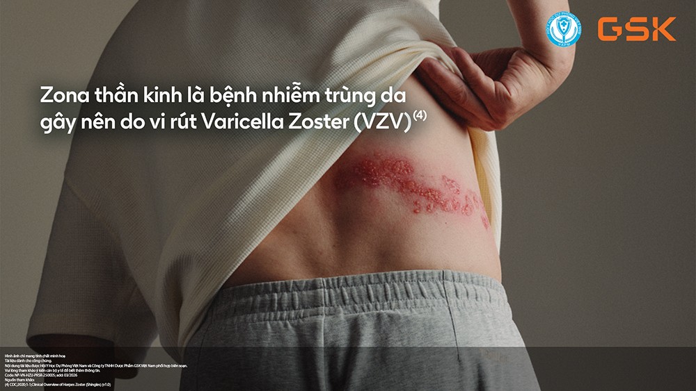 Zona thần kinh không chỉ là vết ban da? Hiểu đúng để phòng ngừa sớm - 2