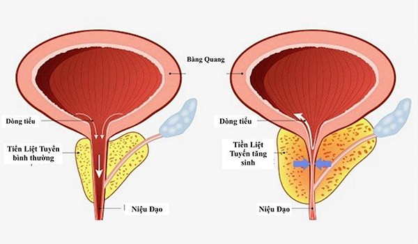 Đi tiểu liên tục nhưng nhỏ giọt như "cà phê phin": Thủ phạm khiến nhiều quý ông bất ngờ - 2
