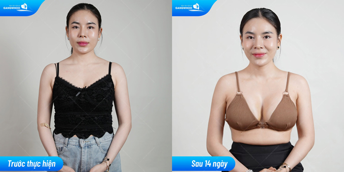 Nâng ngực Tissue Preservation tại Bệnh viện Thẩm mỹ Gangwhoo – Giải pháp nâng ngực trong 30 phút - 1