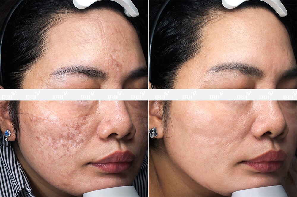 DRH Clinic Gò Vấp – chuẩn mực mới phục hồi da biến chứng tại TP.HCM - 5