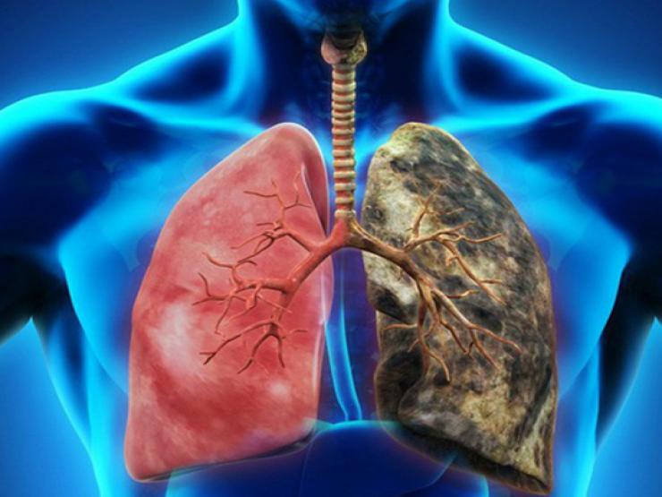 Người đàn ông phát hiện ung thư phổi sau đau ngực, ho khan - 1