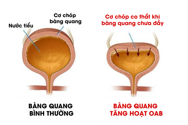&#34;Bệnh lạ&#34; tiểu gấp khi nghe tiếng nước chảy, tiểu đêm, tiểu nhiều liên tục ban ngày - 2