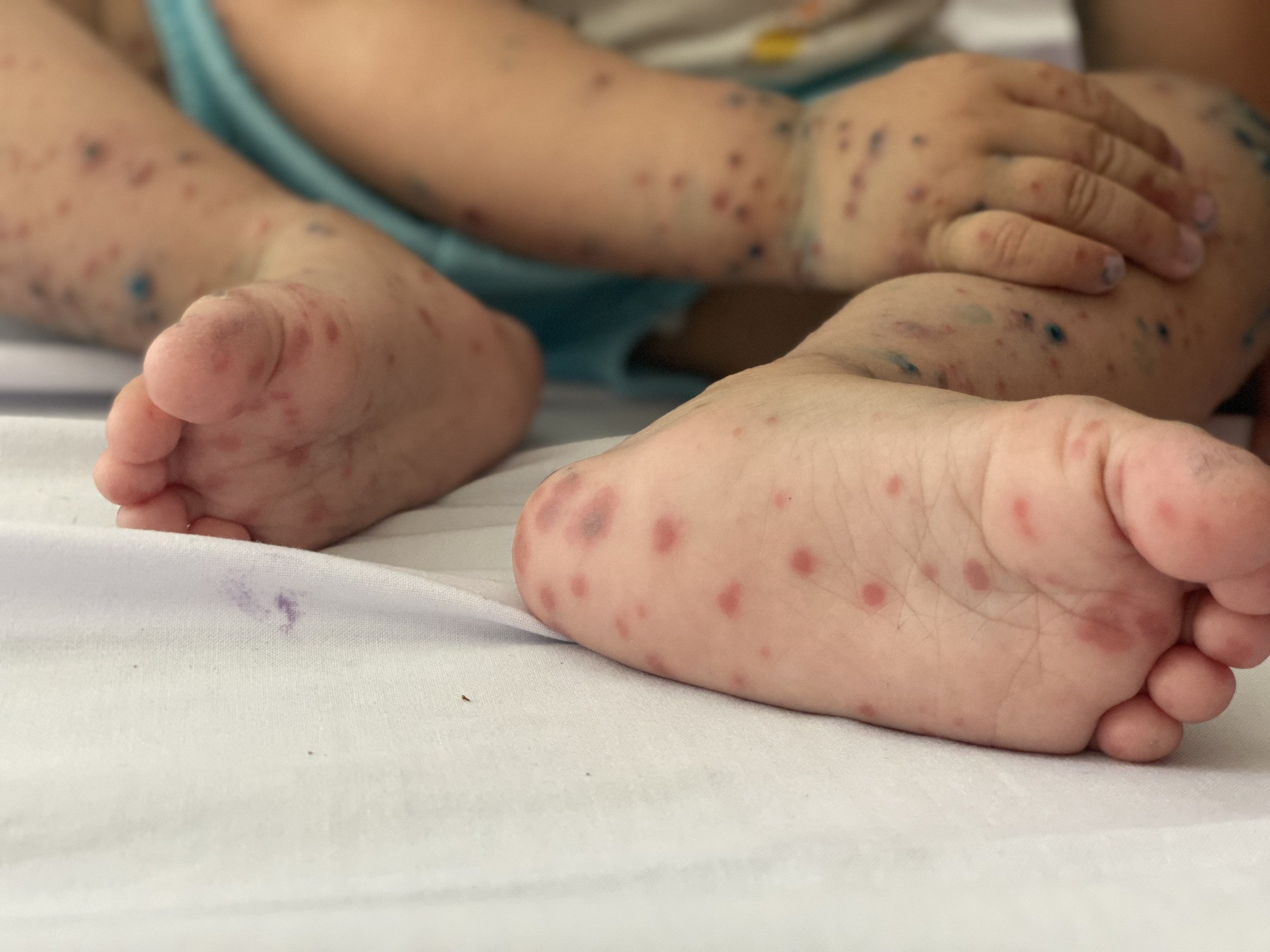 “Combo” tựu trường, giao mùa khiến trẻ dễ mắc đủ thức bệnh, cha mẹ chớ chủ quan! - 2