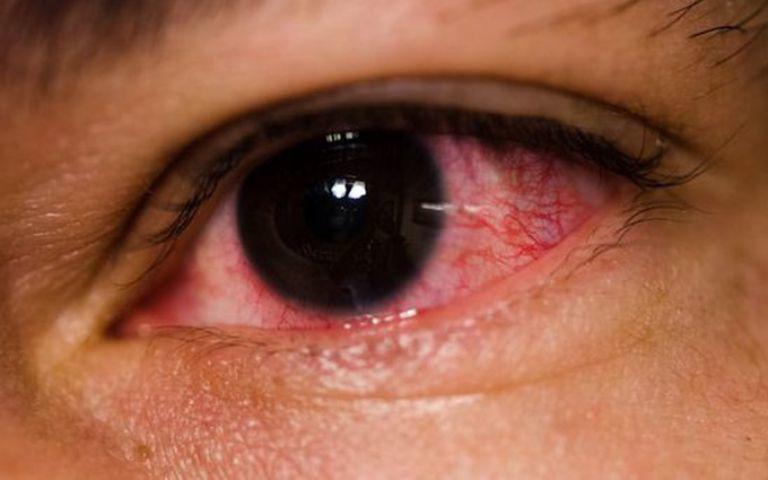 Bộ Y tế hướng dẫn cách xử trí khi bị đau mắt đỏ - 1