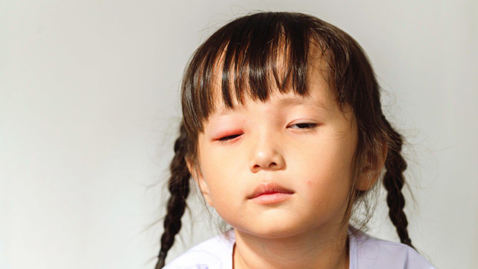 Đau mắt đỏ không nhỏ kháng sinh, cha mẹ cần làm gì để trẻ nhanh hồi phục? - 1