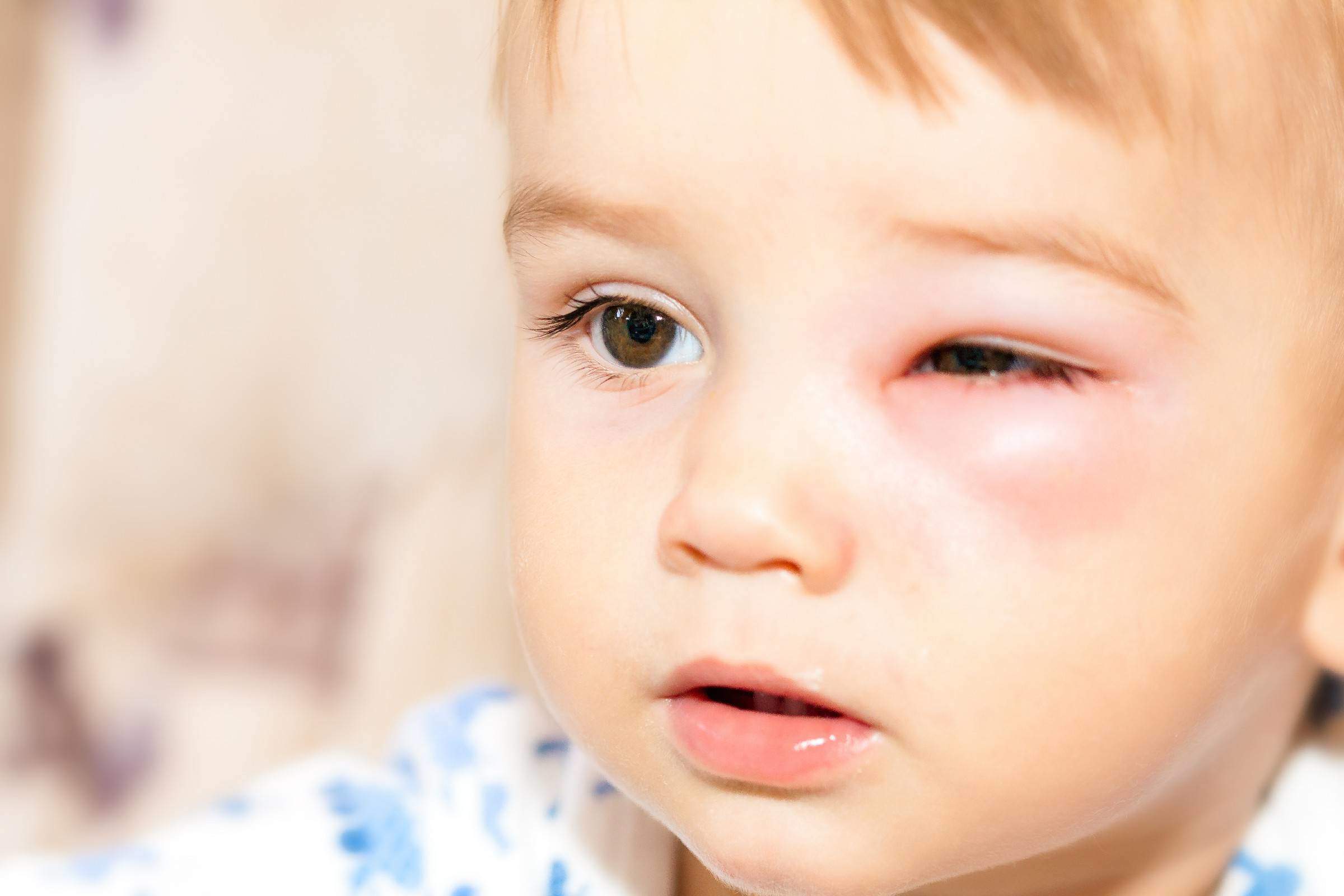Đau mắt đỏ không nhỏ kháng sinh, cha mẹ cần làm gì để trẻ nhanh hồi phục? - 2