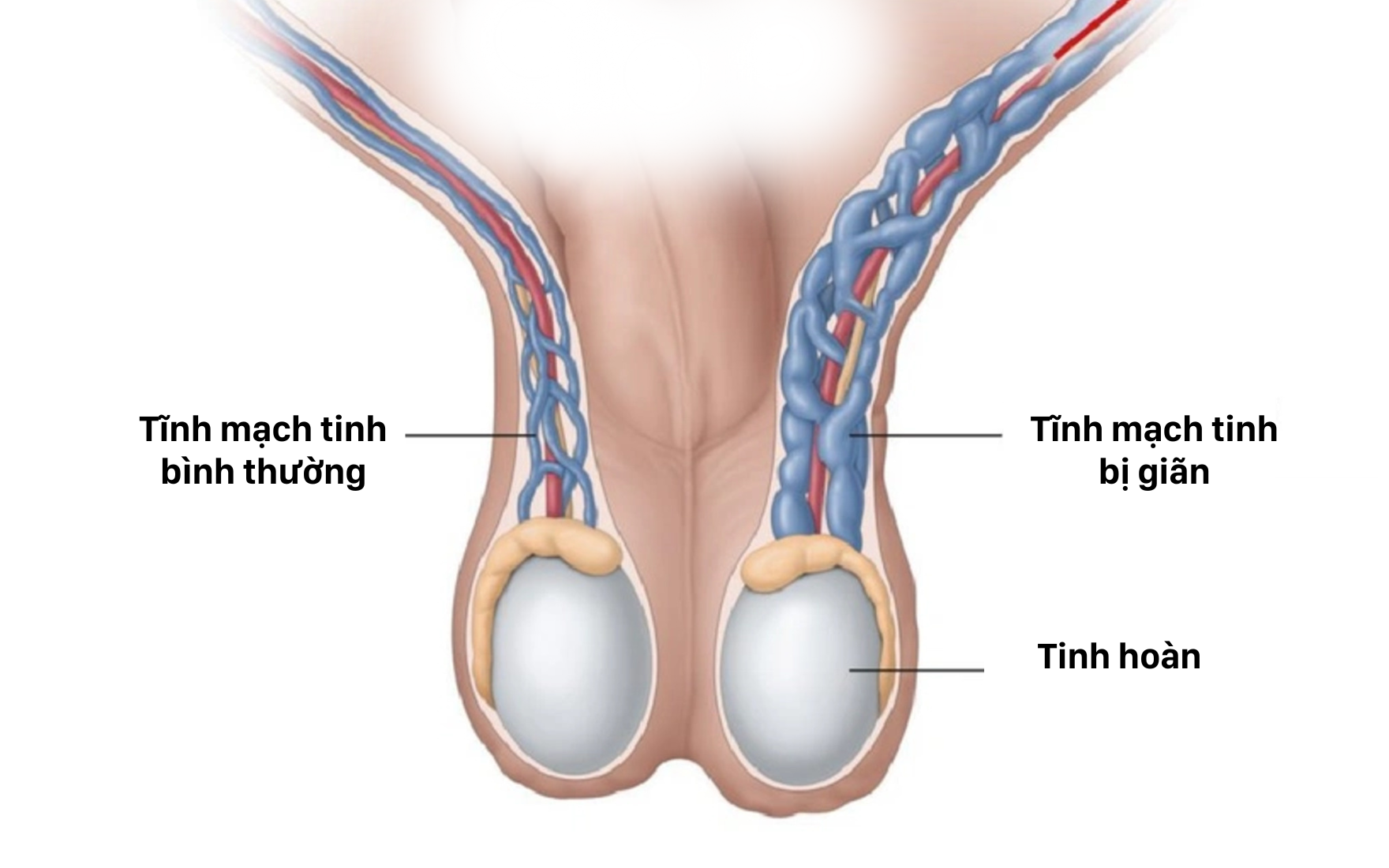 Giãn tĩnh mạch thừng tinh - “thủ phạm” gây vô sinh phổ biến ở nam giới - 1