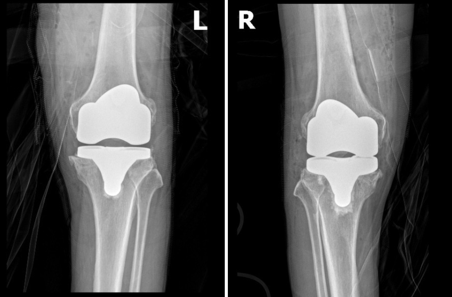 Bệnh viện Hồng Ngọc tiên phong thay 2 khớp gối không cắt gân cơ trong 1 cuộc mổ - 3