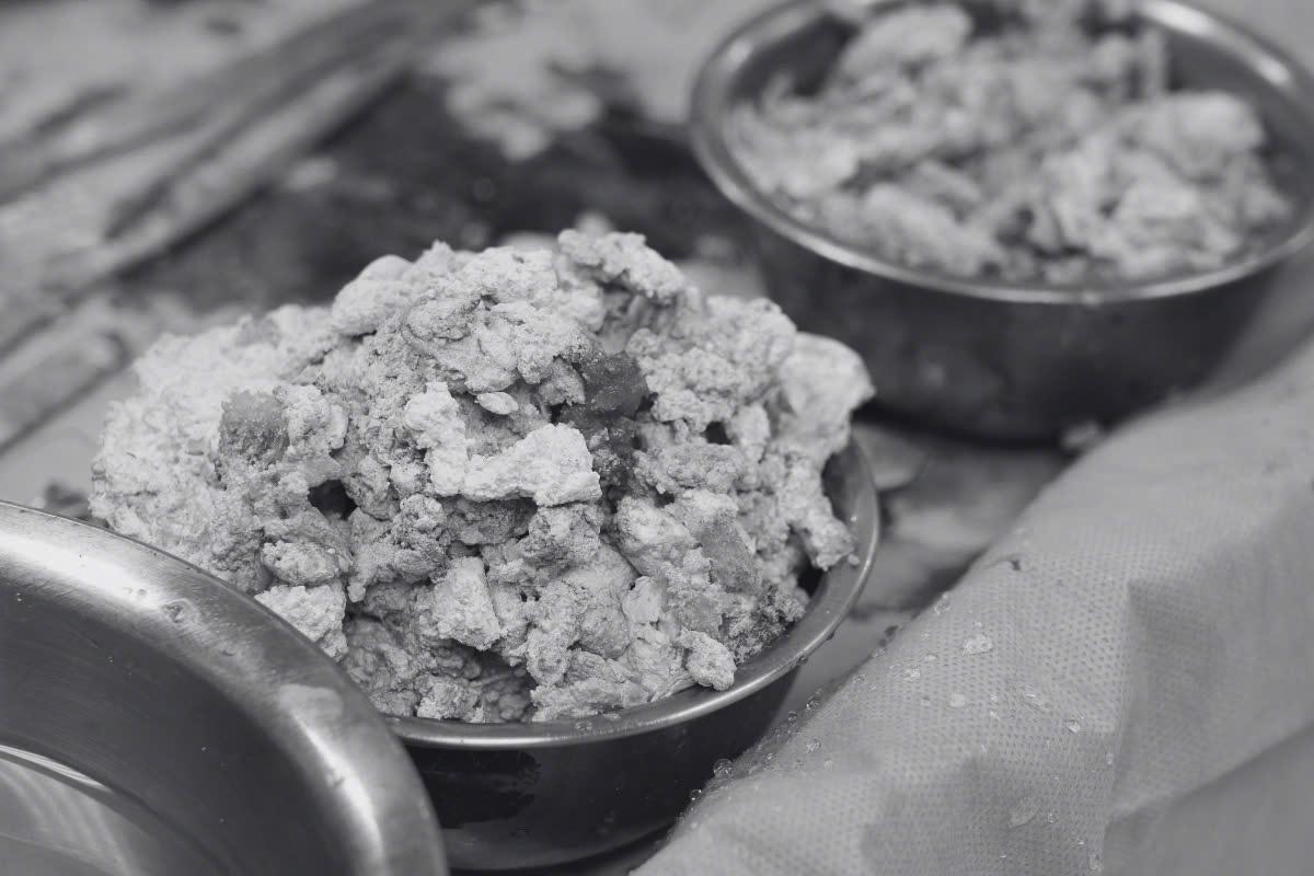 Bệnh viện Hồng Ngọc tiên phong thay 2 khớp gối không cắt gân cơ trong 1 cuộc mổ - 2