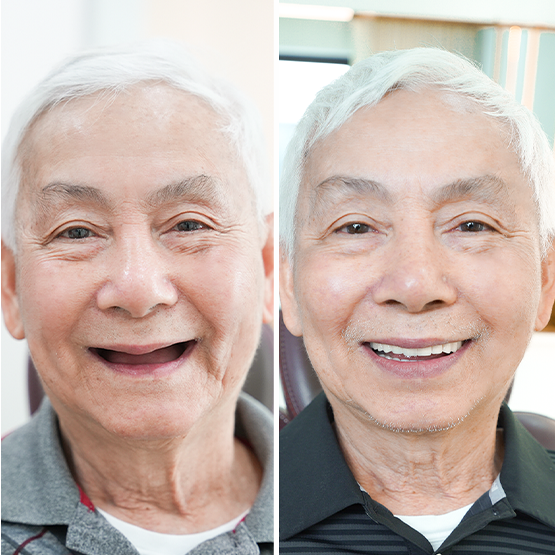 Bio Implant – Đột phá công nghệ trồng răng không đau, ăn nhai sau 48 giờ tại nha khoa Delia - 4