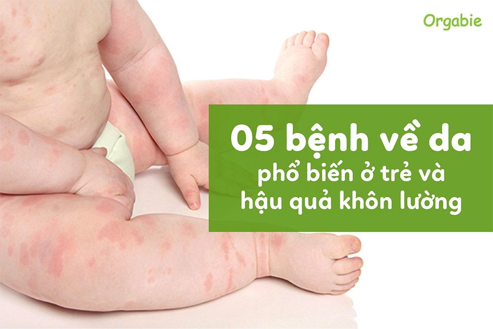 5 bệnh về da phổ biến ở trẻ và hậu quả khôn lường nếu mẹ lơ là - 1